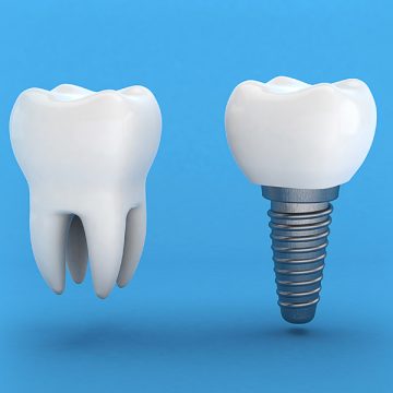 What to Expect When Getting a Dental Implant?