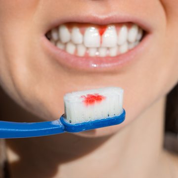 What Helps Gums Heal Faster after Extraction?