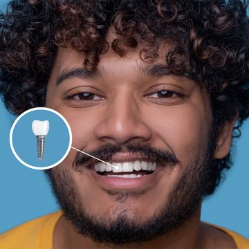 Dental Implants in Columbia, MO: Top Questions Answered by Experts