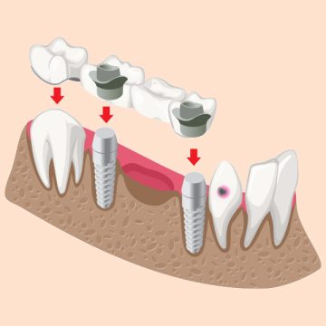 Top Reasons to Get a Dental Bridge in Columbia, MO (And What to Expect)