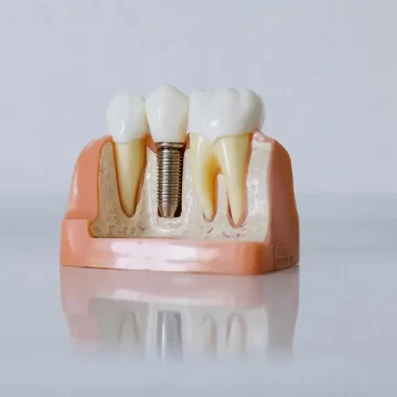 How Long Do Dental Implants Take in Columbia, MO? A Realistic Timeline for 2026