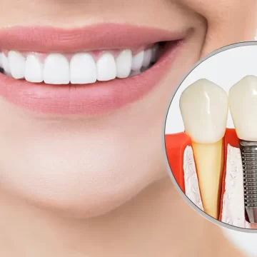 Not Sure About Dental Implants? These 10 Questions Can Help You Decide